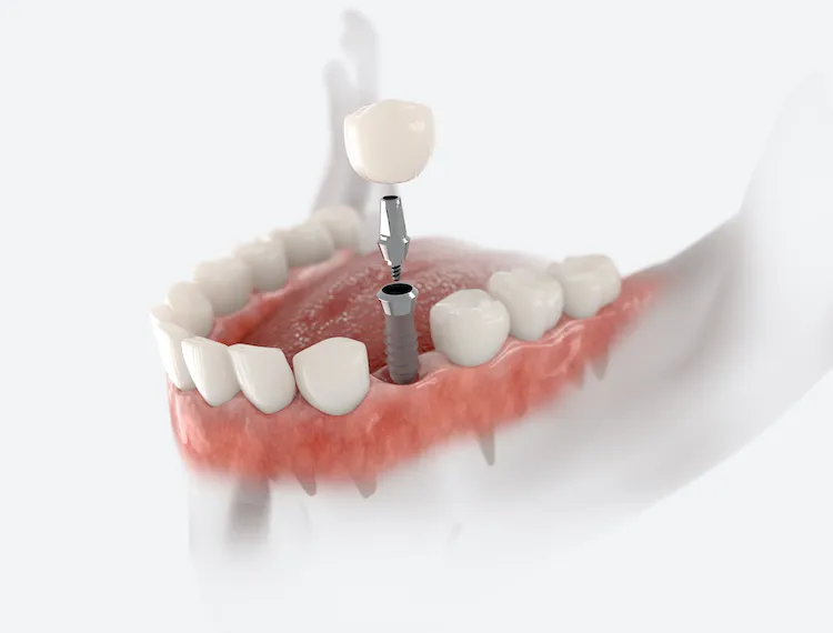 Dental Implants: Getting Close to Natural Teeth in Bryn Mawr, PA